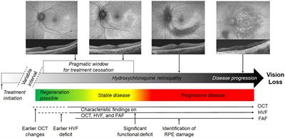 Unmet needs and future perspectives in hydroxychloroquine retinopathy